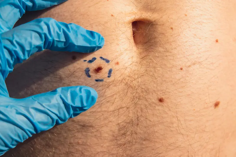 Symptoms of Skin Tumors