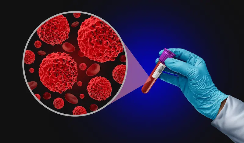 Tumor Marker Blood Test in Turkey
