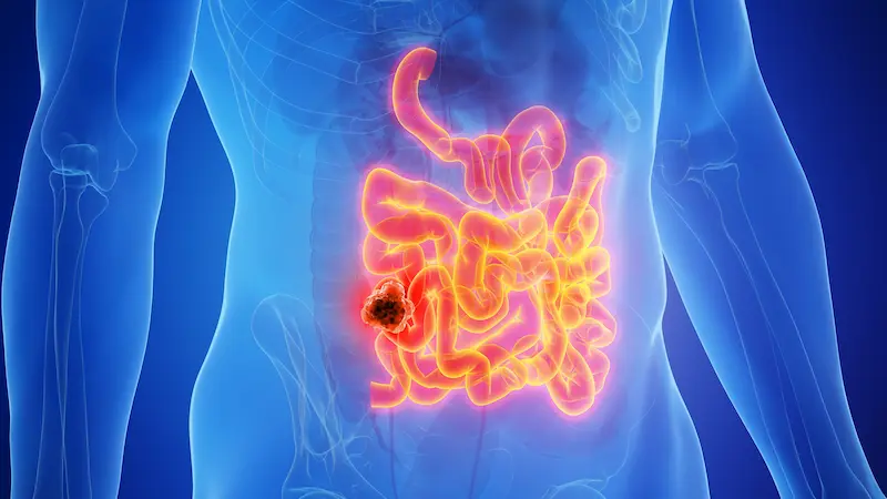 What is Bowel Cancer?