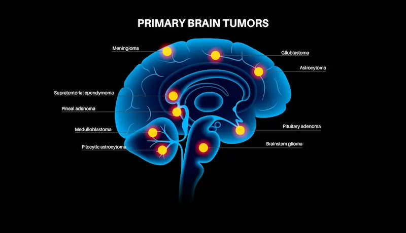 Brain Tumors
