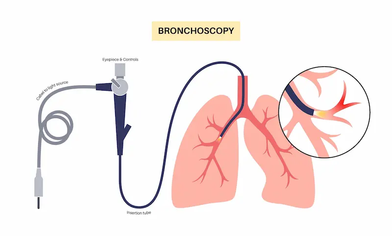 Bronchoscopy Procedure
