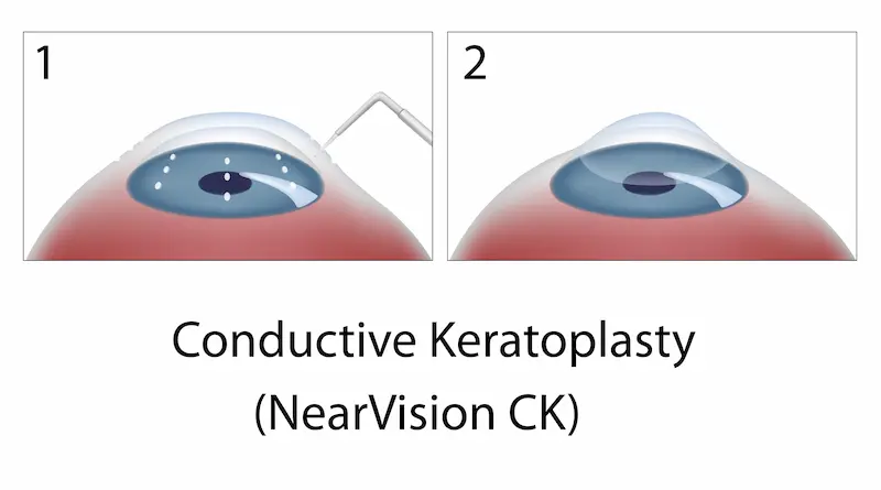 Conductive Keratoplasty