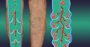 Endoscopic Vein Surgery in Turkey