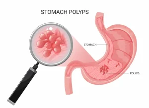Gastric Polyps Removal in Turkey