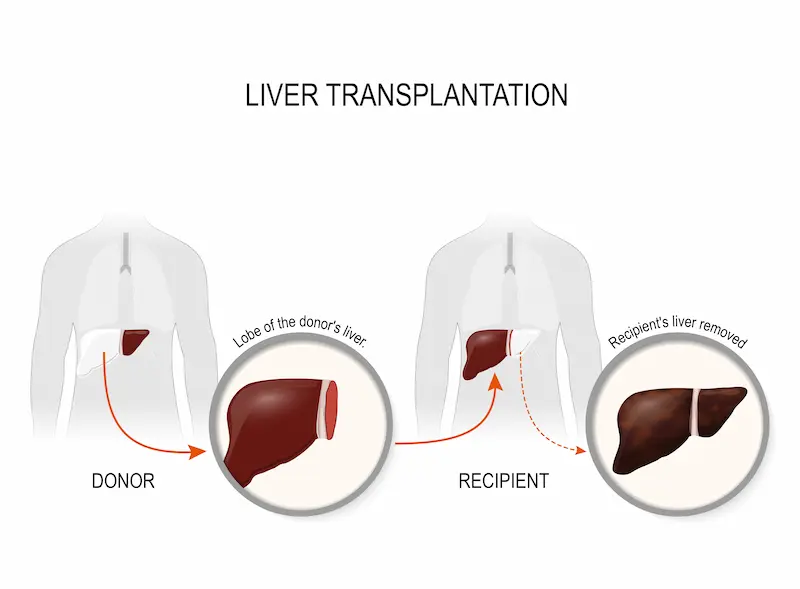Liver Transplantation