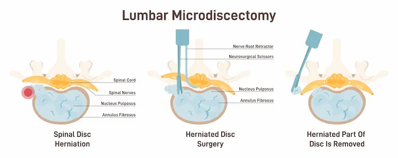 Microdiscectomy