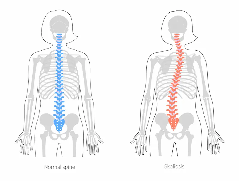 Normal Spine vs Scoliosis