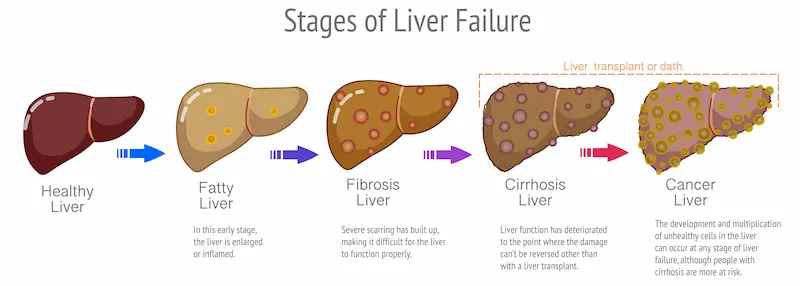 Stages of Liver Failure