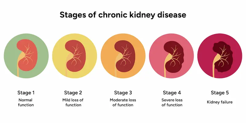 Stages of chronic kidney diseases