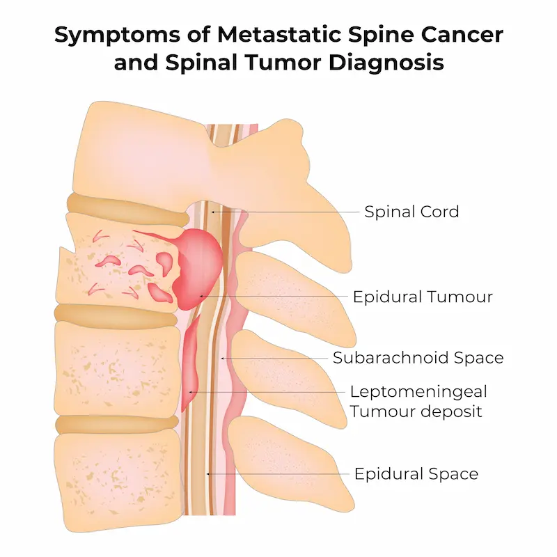 Symptoms of Metastatic Spine Cancer and Spinal Tumor Diagnosis