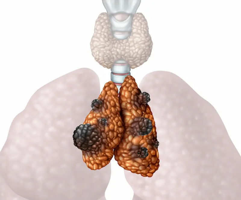 Thymus Cancer