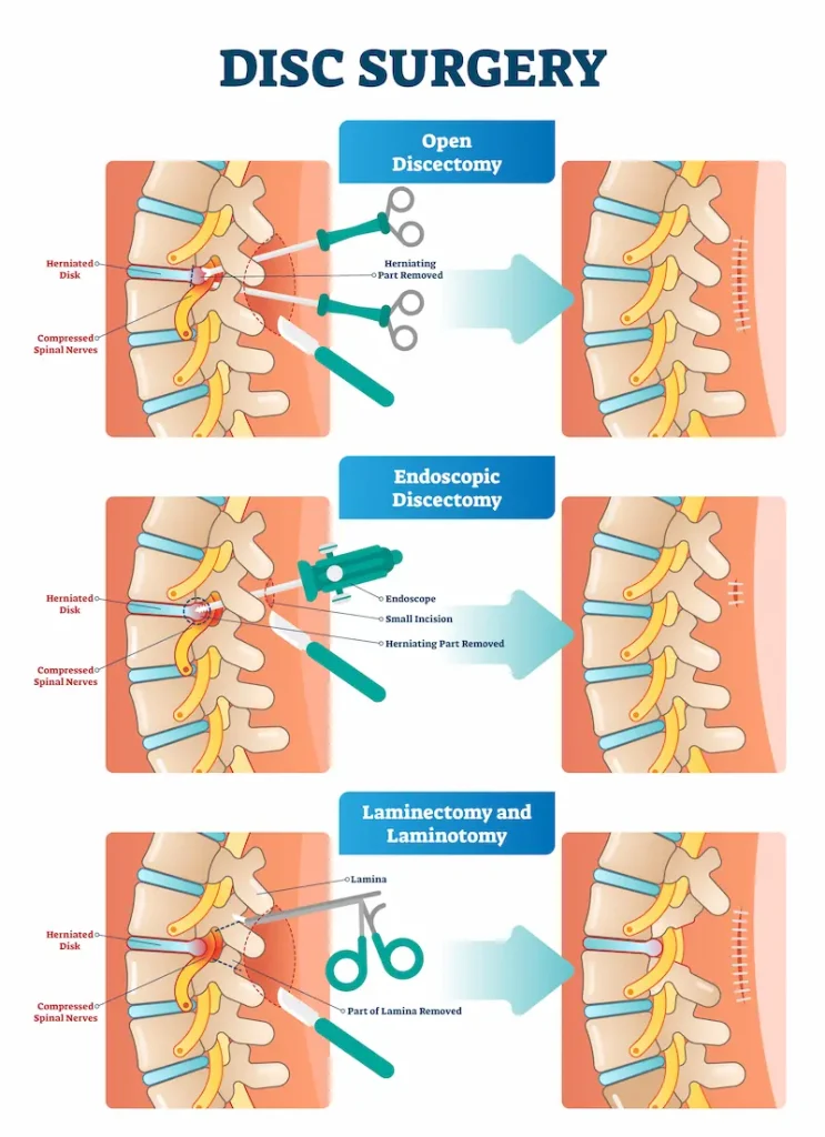 Types of Disc Surgery