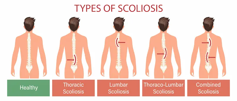 Types of Scoliosis