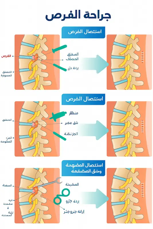 أنواع جراحة القرص