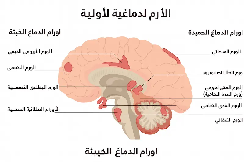 أورام الدماغ الأولية