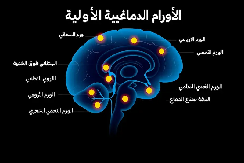 أورام المخ
