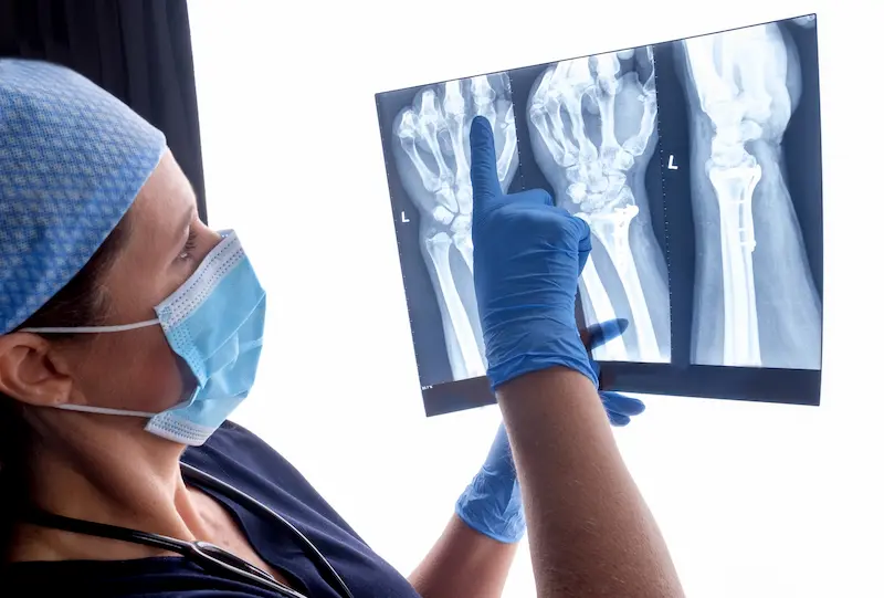 Ganglion Cyst Removal