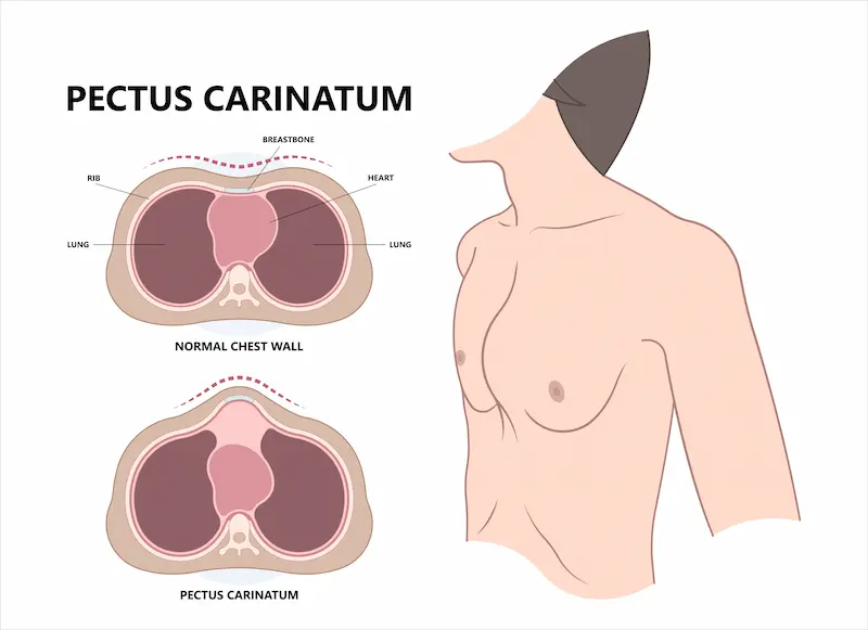 Килевидная деформация грудной клетки (Pectus Carinatum): инфографика, сравнивающая нормальное строение грудной клетки и выпячивание грудины.