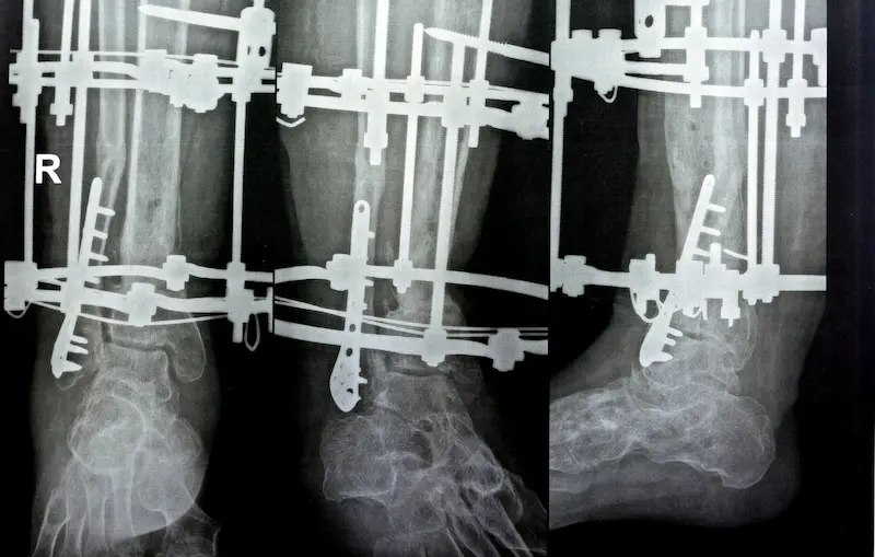 Limb Lengthening Surgery Ilızarov