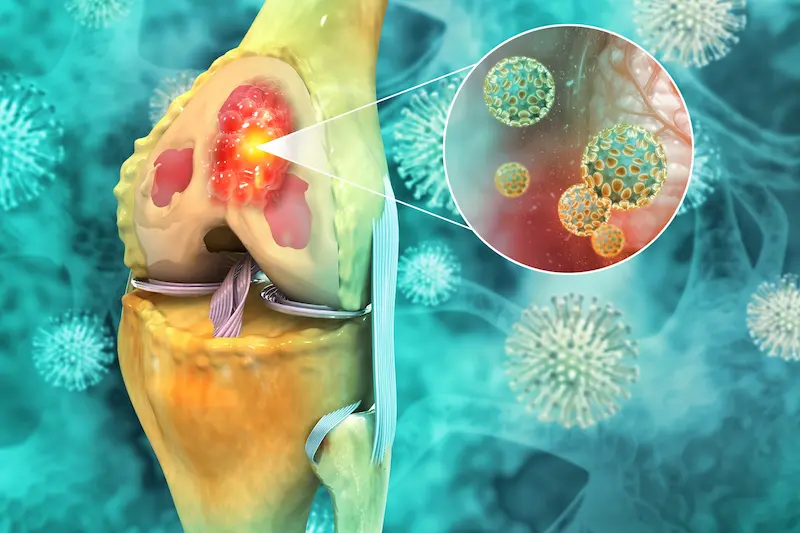 Orthopedic Tumor Surgery Cost