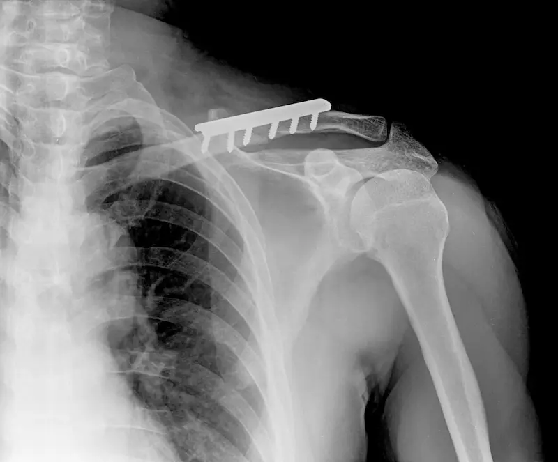 Shoulder Replacement Cost in Turkey