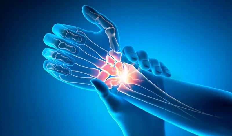 Wrist Surgery in Turkey