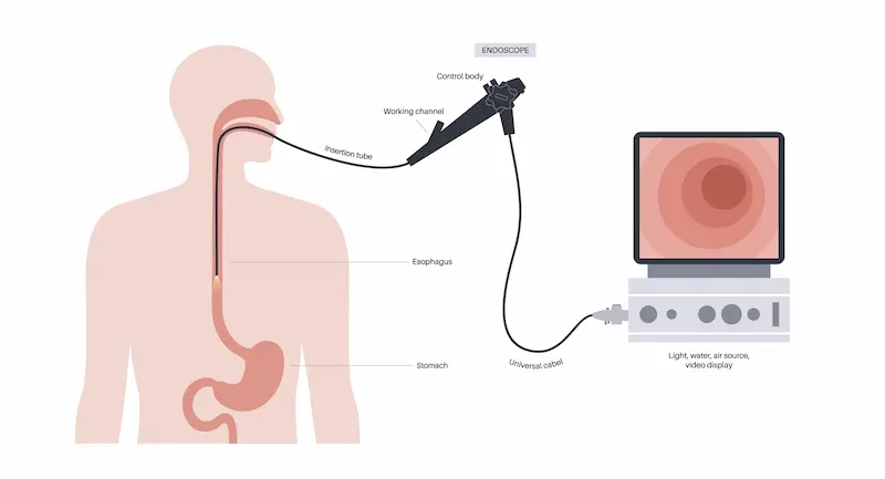 Endoscopy