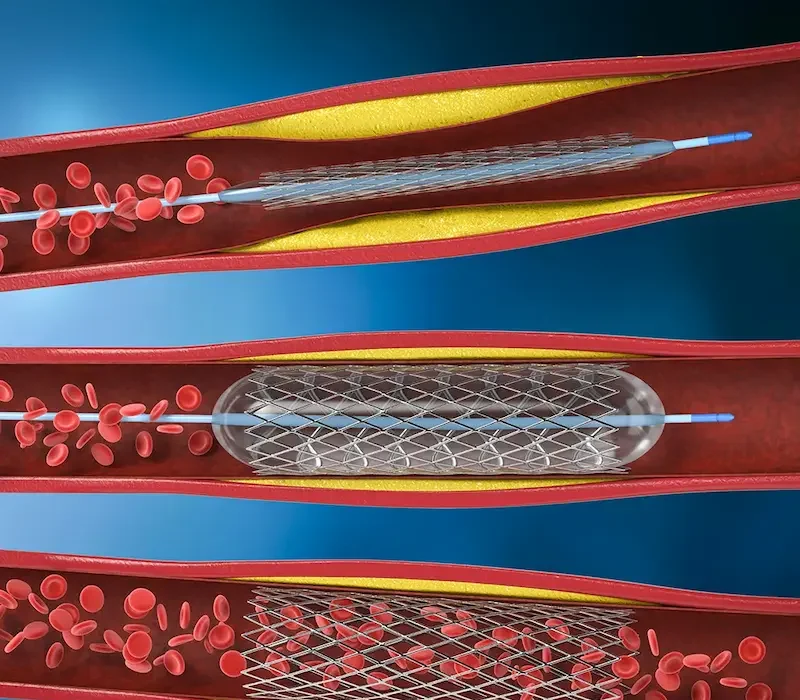 Stent Placement Procedure