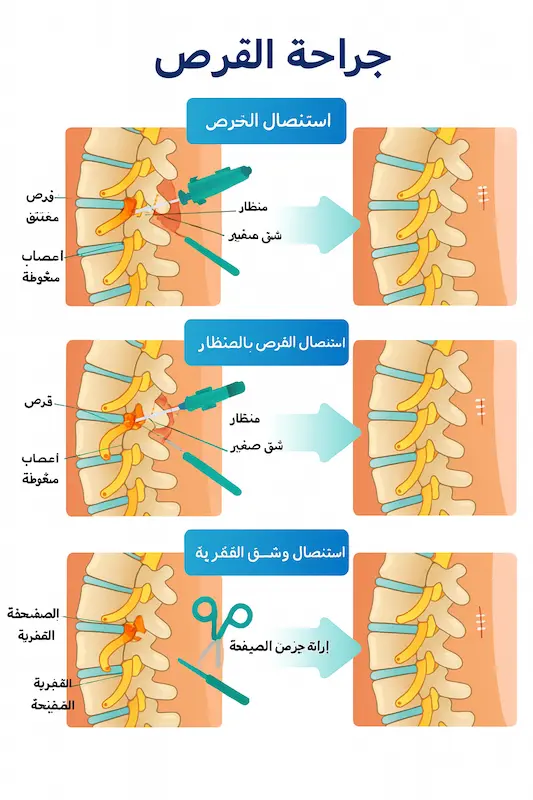 خيارات جراحة القرص