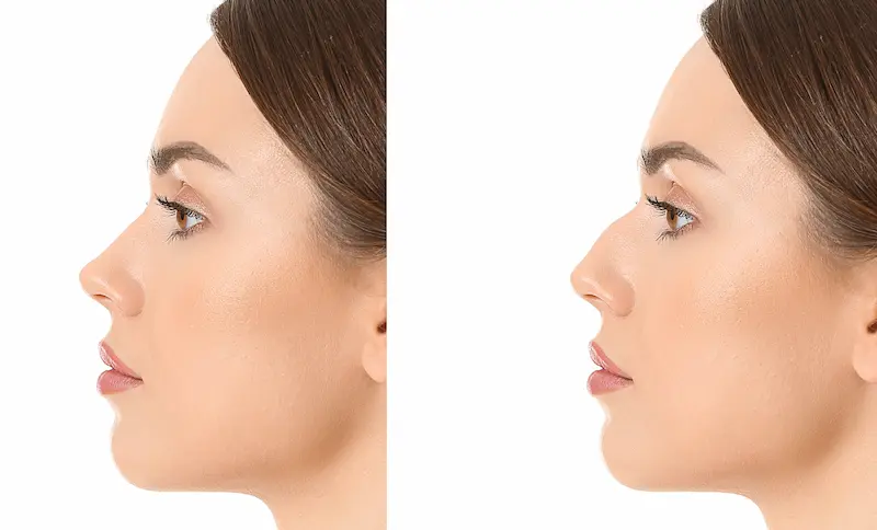 تجميل الأنف قبل وبعد