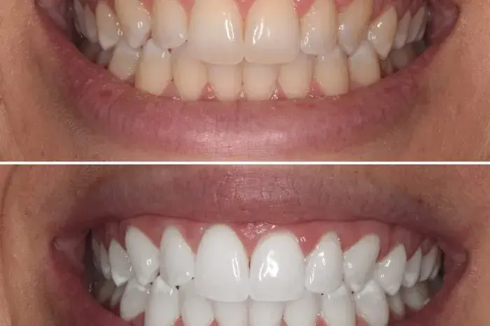 Advantages of Teeth Whitening