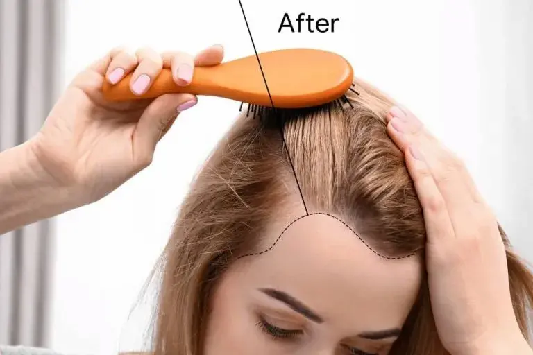 Causes Of Hair Loss In Women