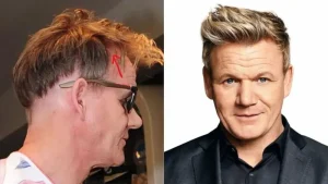 Celebrities With Hair Transplants