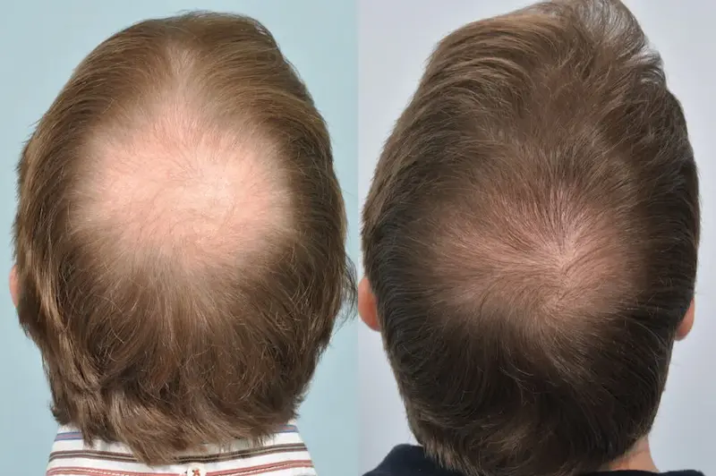 Crown Hair Transplant Cost