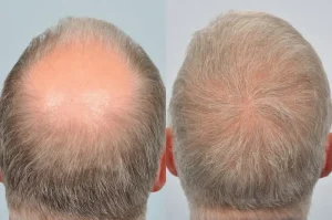 crown hair transplant