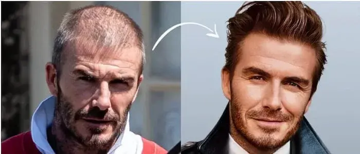 David Beckham Hair Transplant