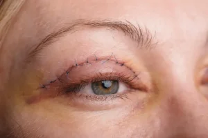 double eyelid surgery