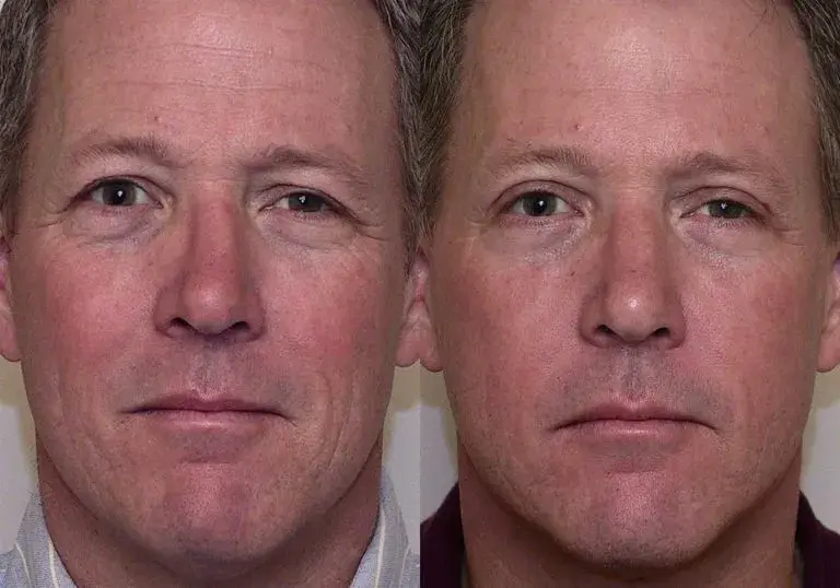 Double Eyelid Surgery Before And After