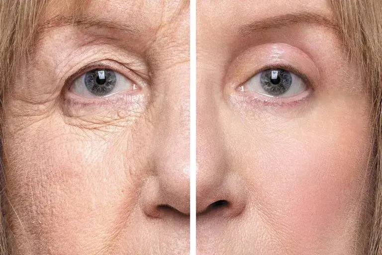 Double Eyelid Surgery Cost