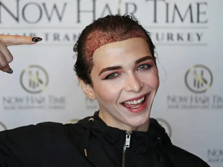 Female Hair Transplant