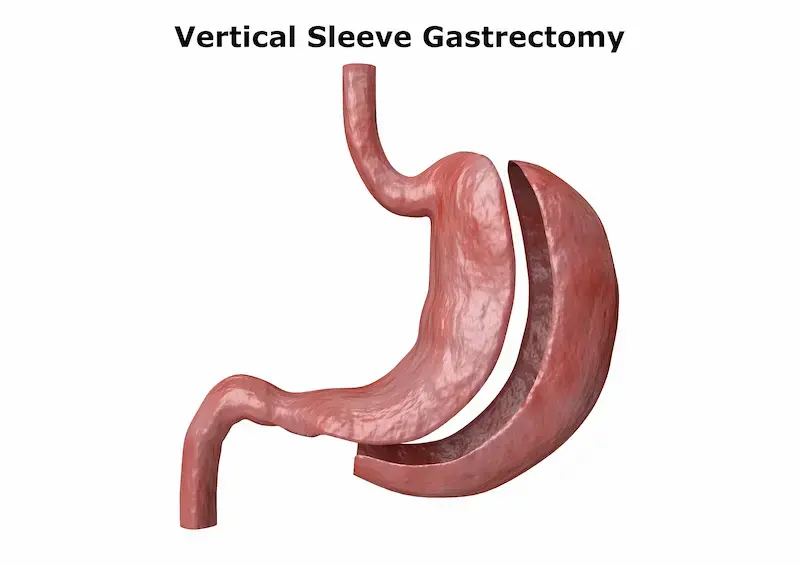 Gastric Sleeve in Turkey