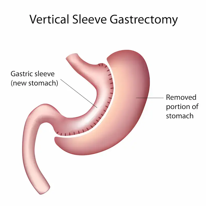 Gatric Sleeve Recovery Time