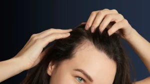 hair transplant for women