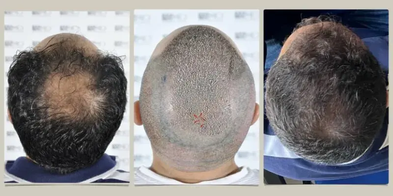 Hair Transplant Process