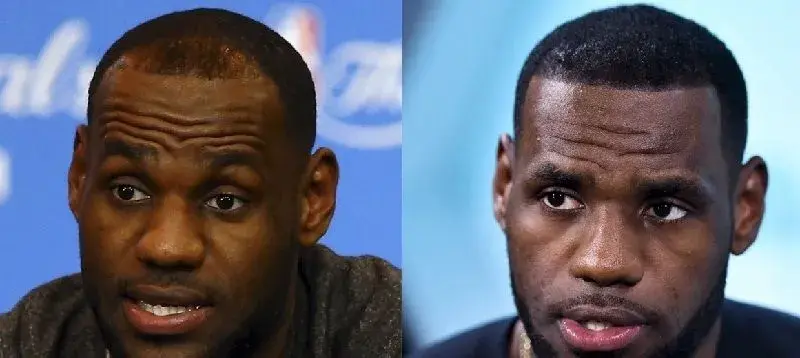 Hair Transplant Techniques
