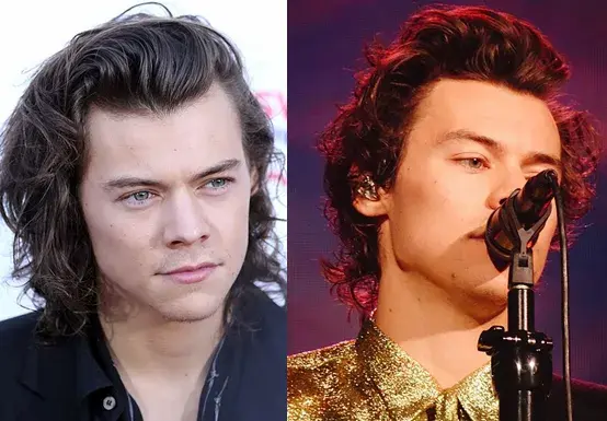 Harry Styles Hair Loss