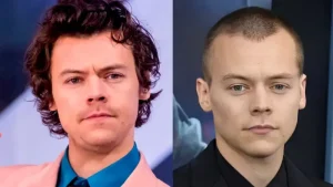 Harry Styles Hair Transplant