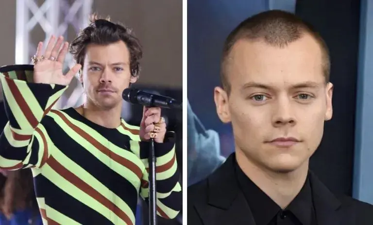 Is Harry Styles Balding