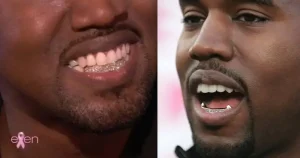 Kanye West Teeth Transformation