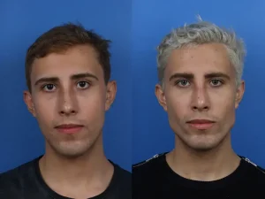 Plastic Surgery for Men